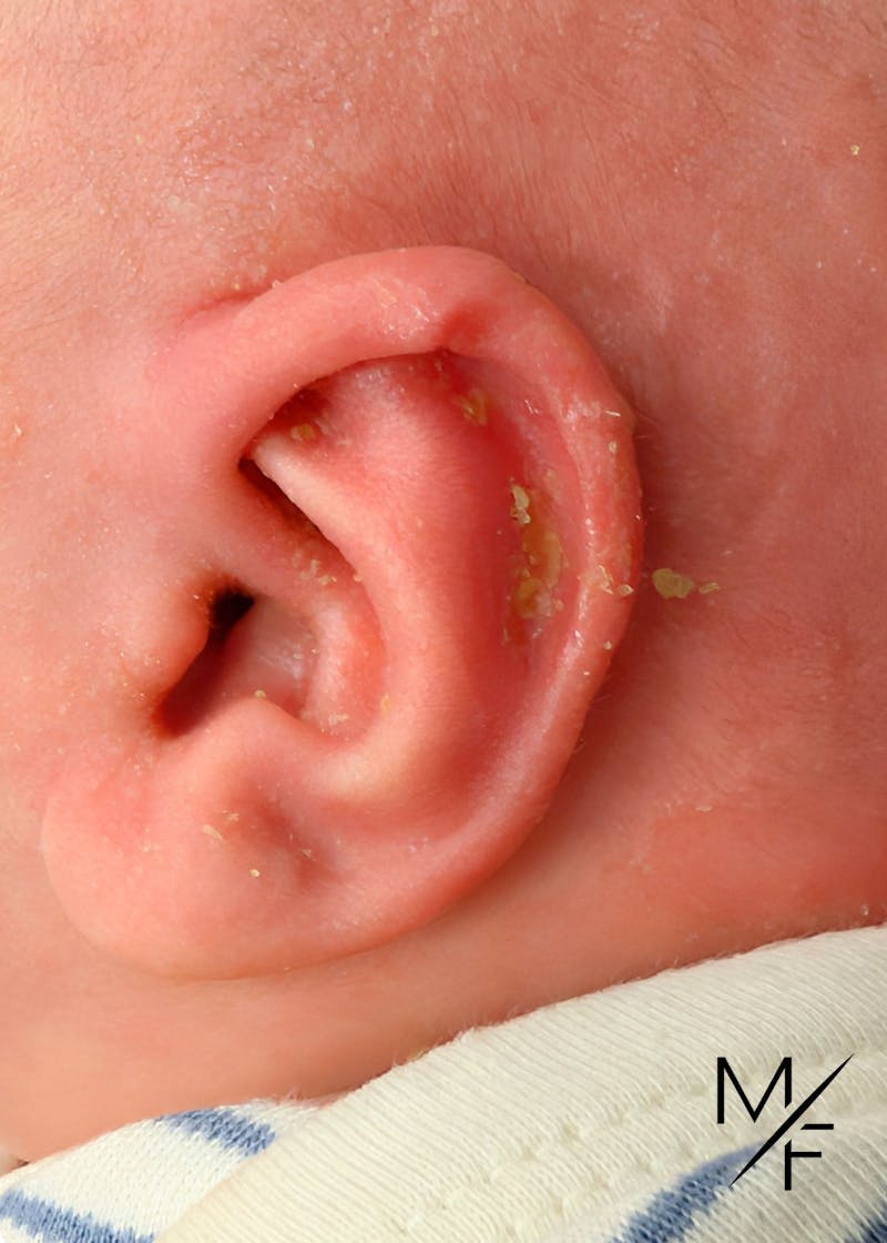 Ear Molding Before & After Gallery - Patient 424016 - Image 2