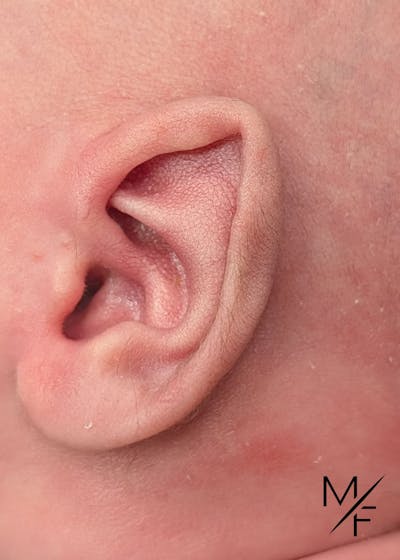 Ear Molding Before & After Gallery - Patient 424016 - Image 1