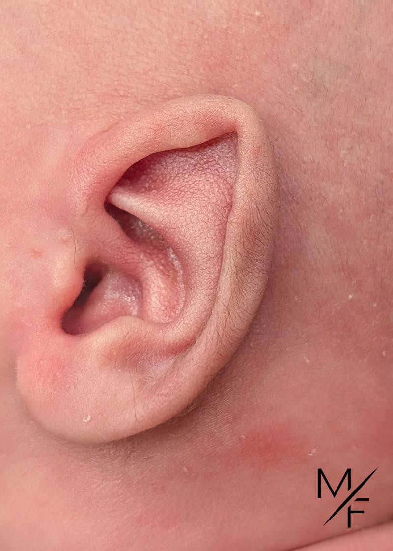 Ear Molding Before & After Gallery - Patient 424016 - Image 1