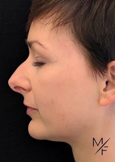 Skin Cancer Reconstruction Before & After Gallery - Patient 738236 - Image 2