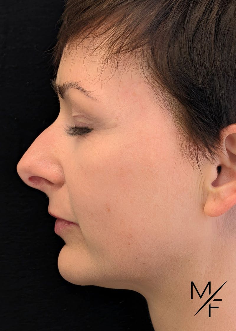 Skin Cancer Reconstruction Before & After Gallery - Patient 738236 - Image 2
