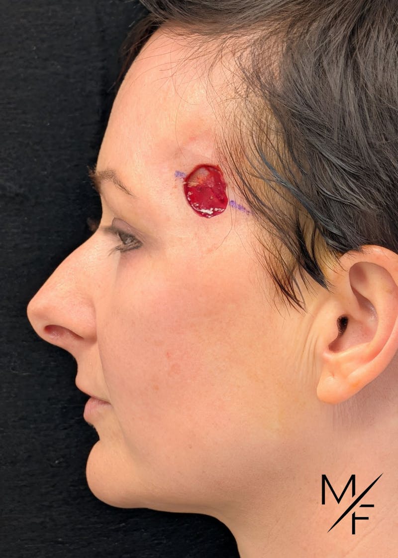 Skin Cancer Reconstruction Before & After Gallery - Patient 738236 - Image 1