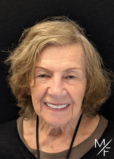 Skin Cancer Reconstruction Before & After Gallery - Patient 219356 - Image 2