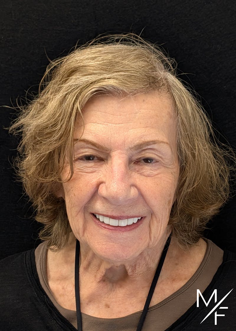 Skin Cancer Reconstruction Before & After Gallery - Patient 219356 - Image 2