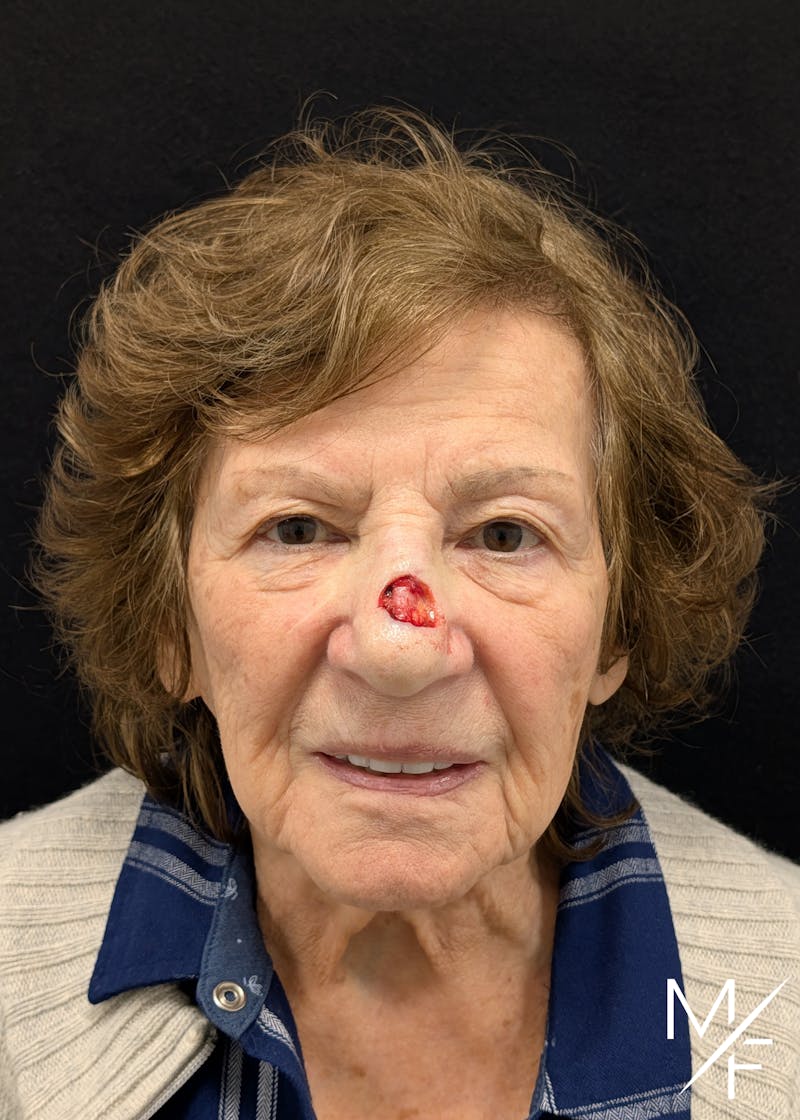 Skin Cancer Reconstruction Before & After Gallery - Patient 219356 - Image 1