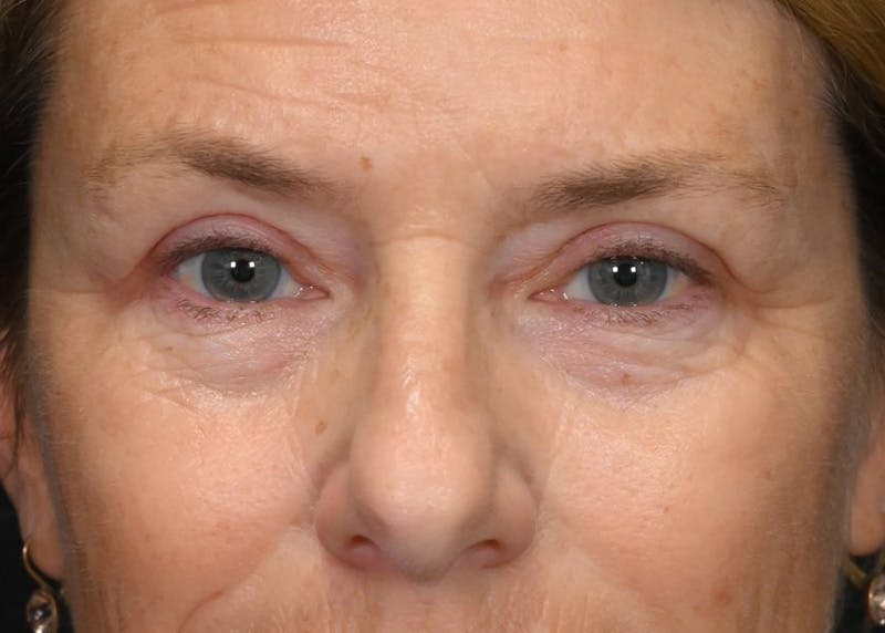 Blepharoplasty Before & After Gallery - Patient 425503 - Image 2