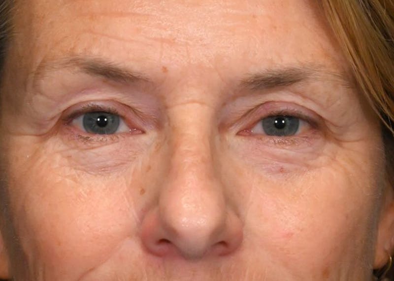 Blepharoplasty Before & After Gallery - Patient 425503 - Image 1