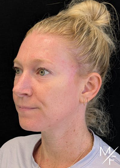 Skin Cancer Reconstruction Before & After Gallery - Patient 137193 - Image 2