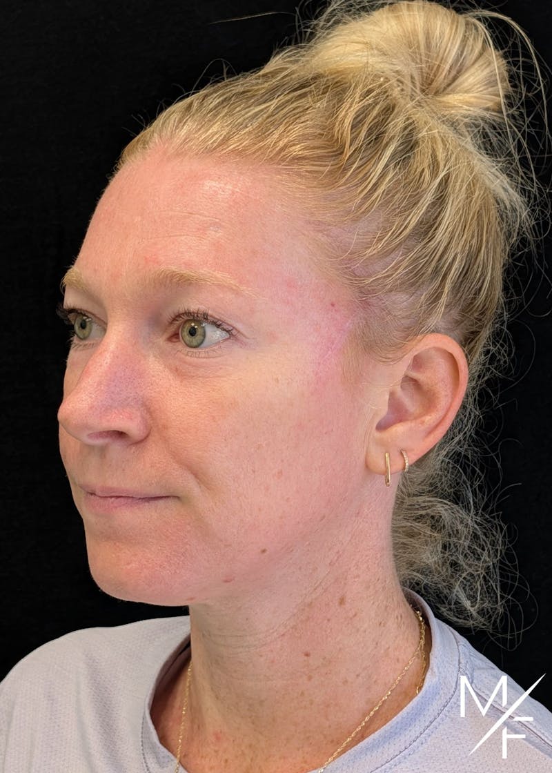 Skin Cancer Reconstruction Before & After Gallery - Patient 137193 - Image 2
