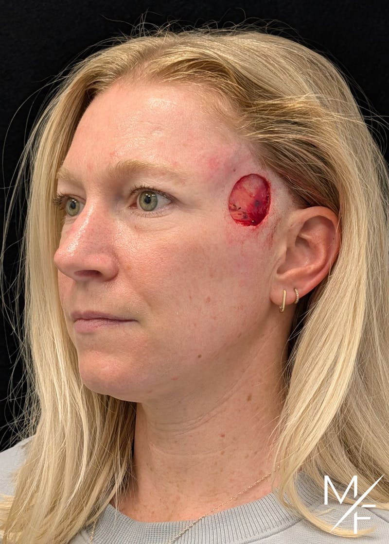 Skin Cancer Reconstruction Before & After Gallery - Patient 137193 - Image 1