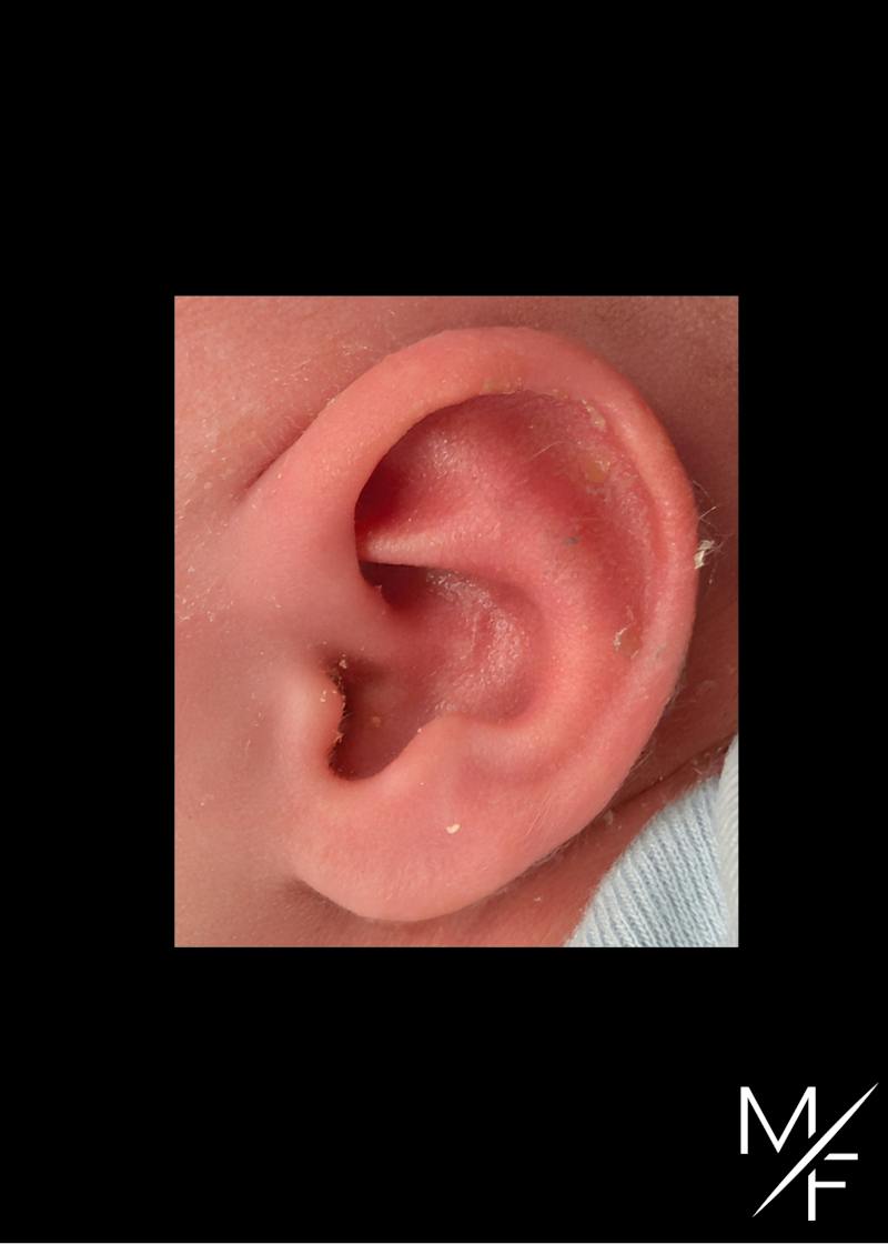 Ear Molding Before & After Gallery - Patient 394134 - Image 2