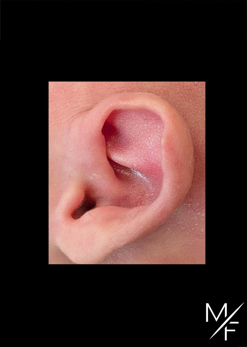 Ear Molding Before & After Gallery - Patient 394134 - Image 1