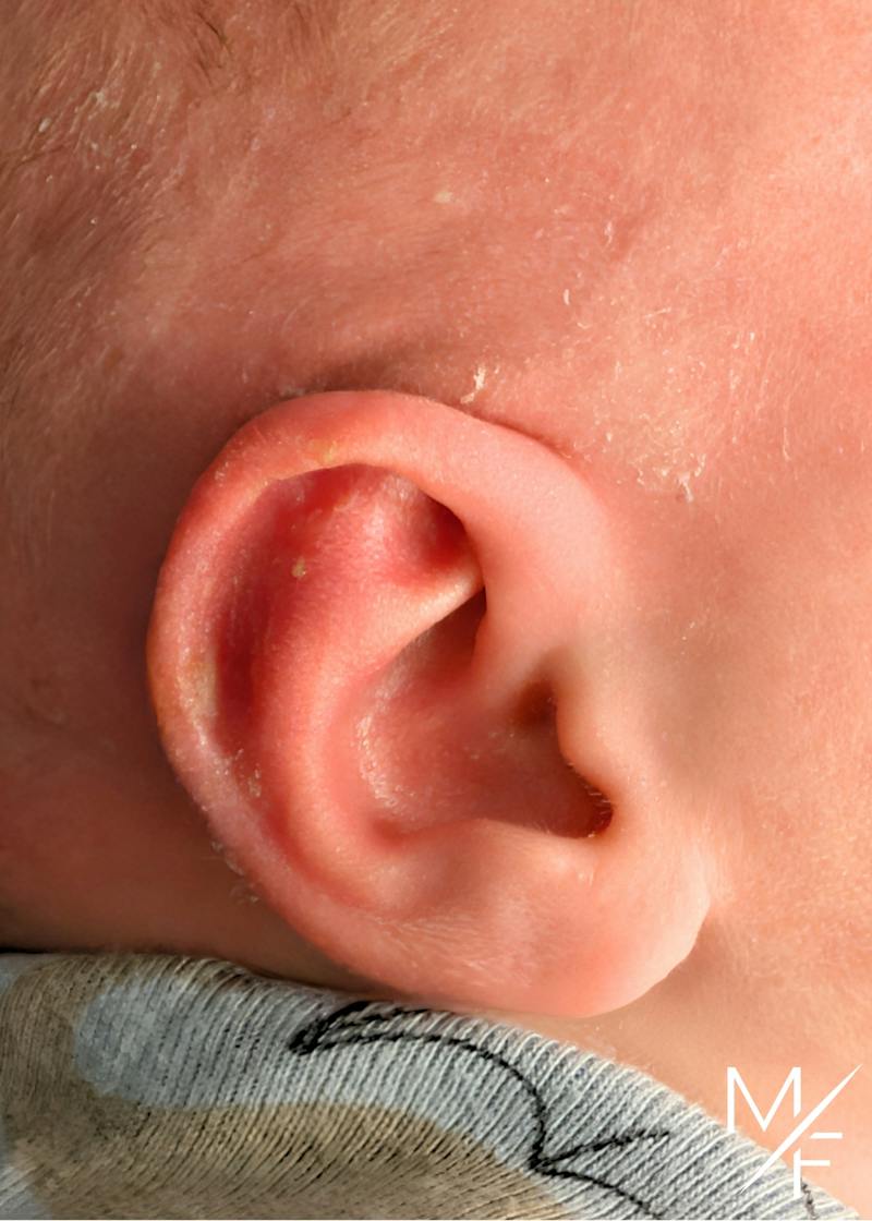 Ear Molding Before & After Gallery - Patient 384986 - Image 2
