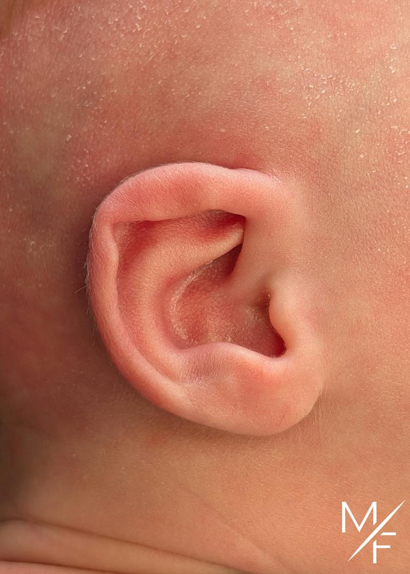 Ear Molding Before & After Gallery - Patient 384986 - Image 1