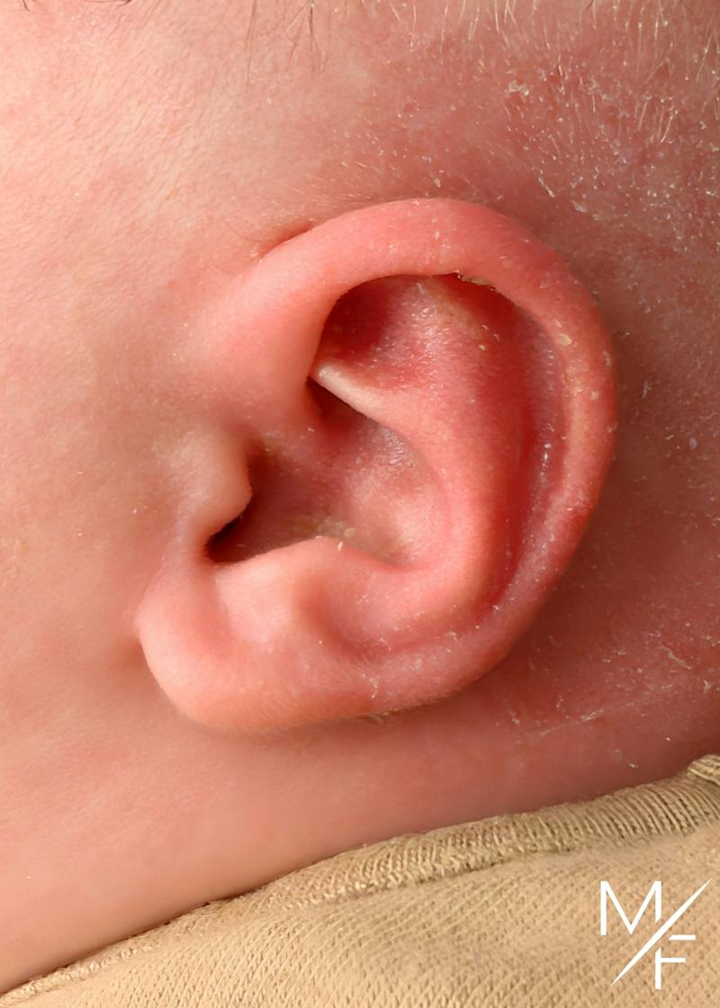 Ear Molding Before & After Gallery - Patient 376264 - Image 2
