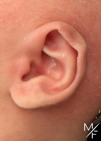Ear Molding Before & After Gallery - Patient 376264 - Image 1