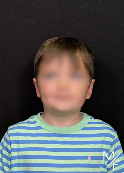 Otoplasty Before & After Gallery - Patient 108663 - Image 2