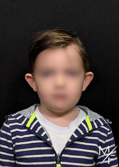 Otoplasty Before & After Gallery - Patient 108663 - Image 1