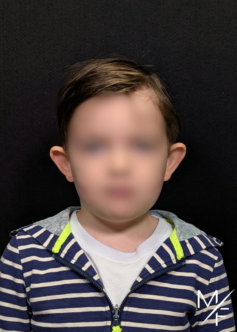 Otoplasty Before & After Gallery - Patient 108663 - Image 1