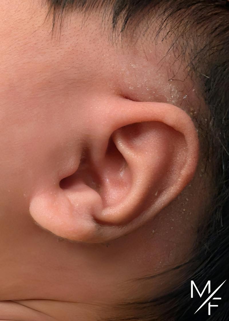Ear Molding Before & After Gallery - Patient 611741 - Image 2