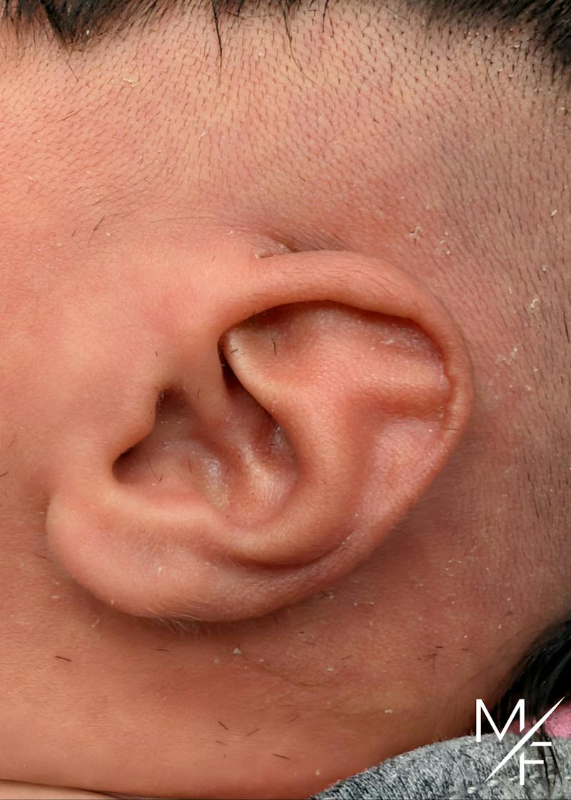 Ear Molding Before & After Gallery - Patient 611741 - Image 1