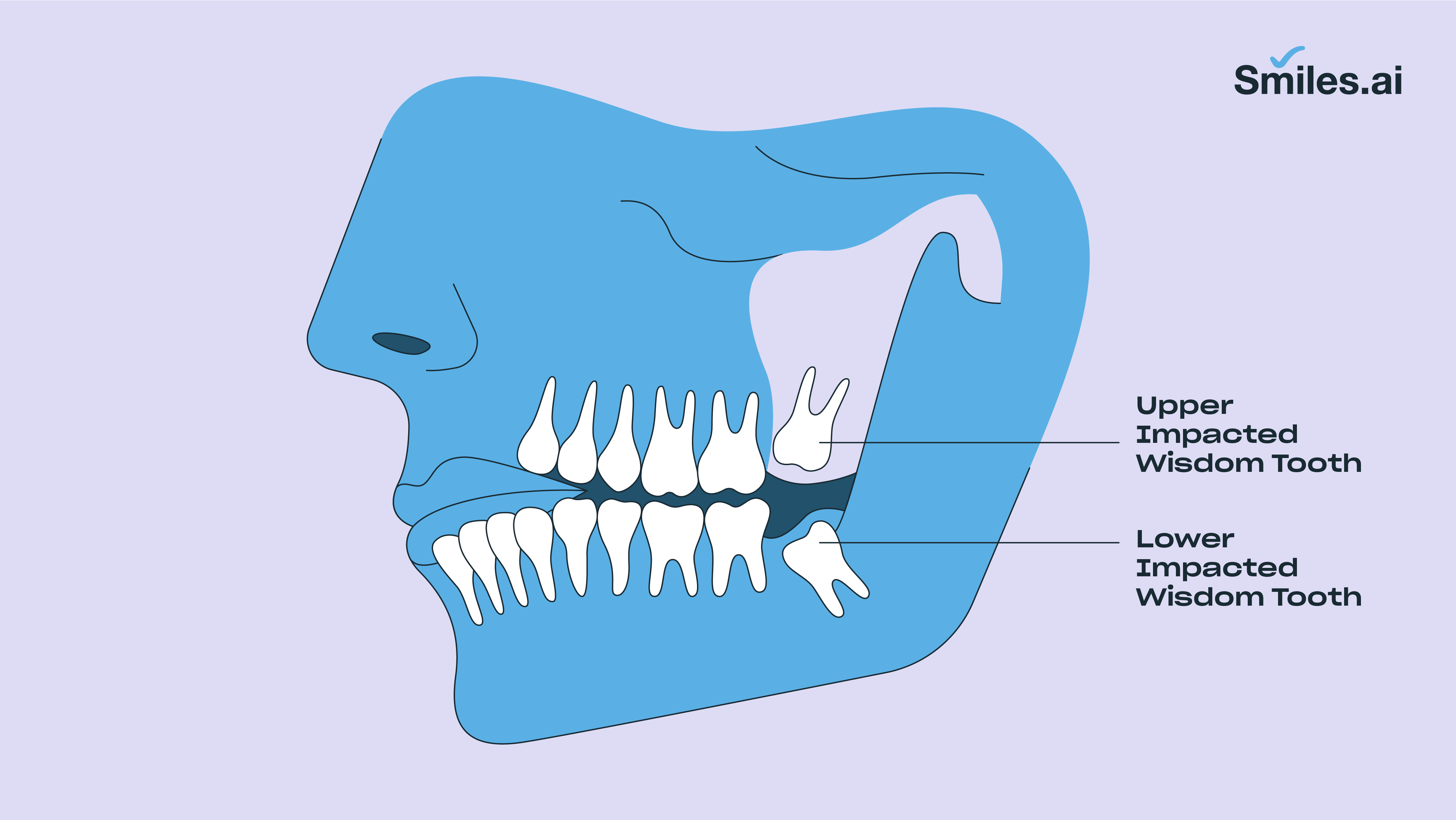 Impacted wisdom tooth 