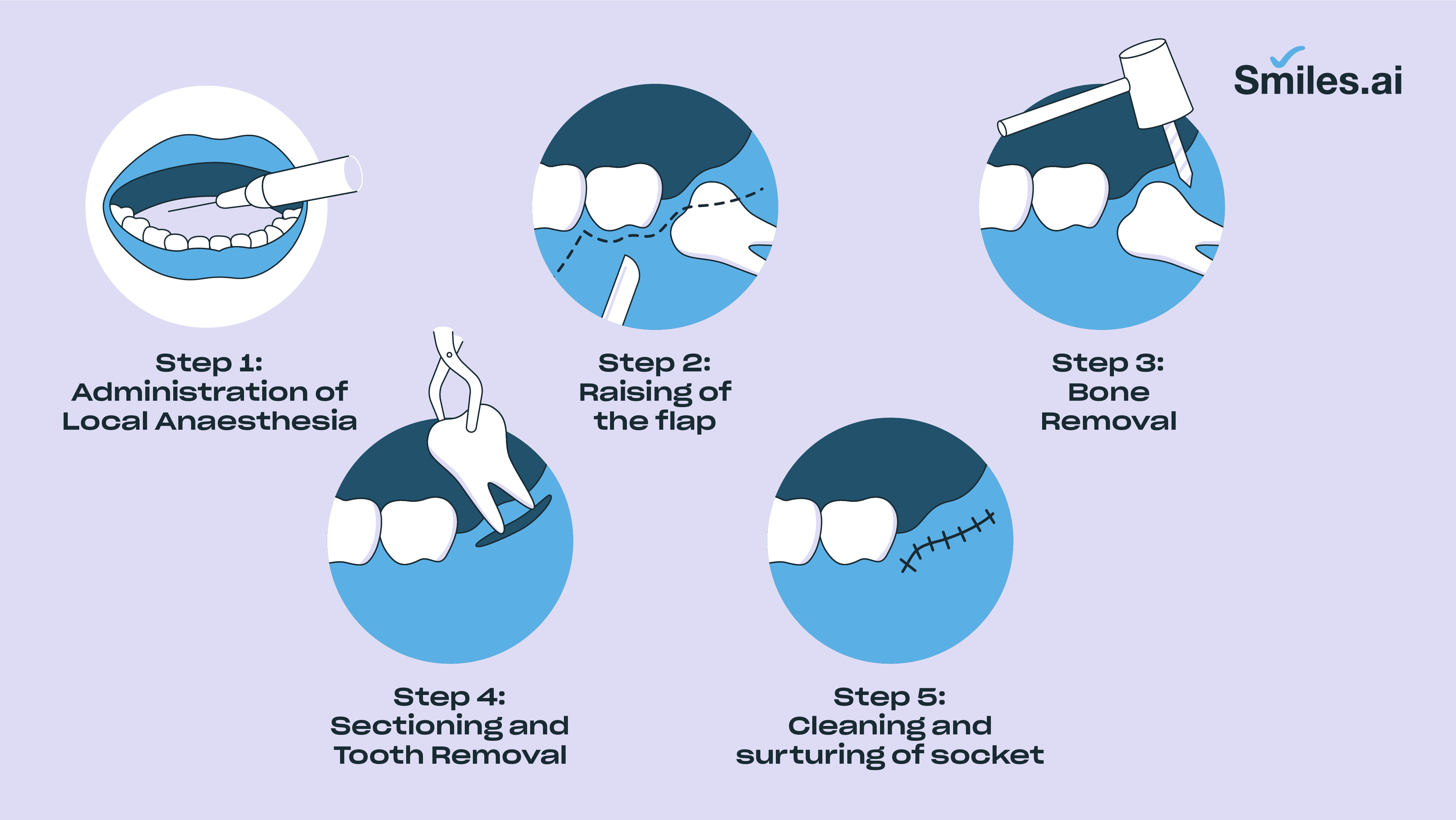 step by step wisdom tooth extraction procedure