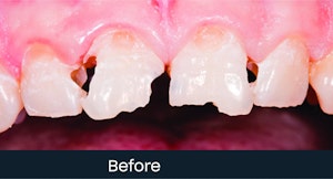 composite bonding teeth