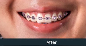 fixed teeth