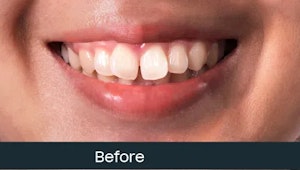 fixed teeth