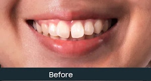 fixed teeth