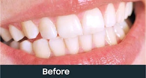 fixed teeth