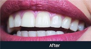 teeth scaling cost