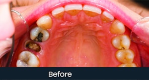 molar extraction
