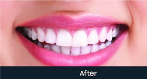 teeth whitening treatment