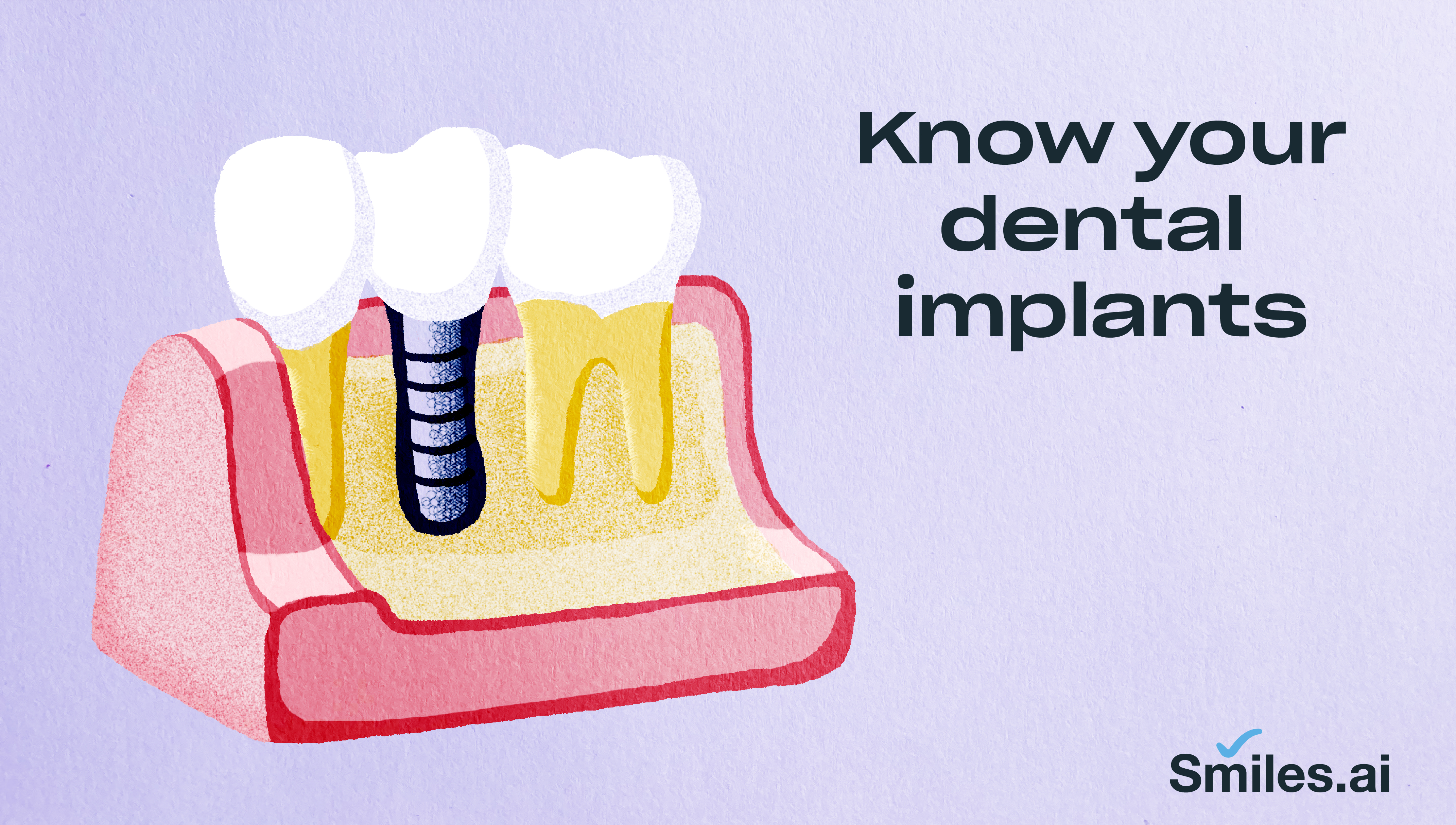 Dental Implants