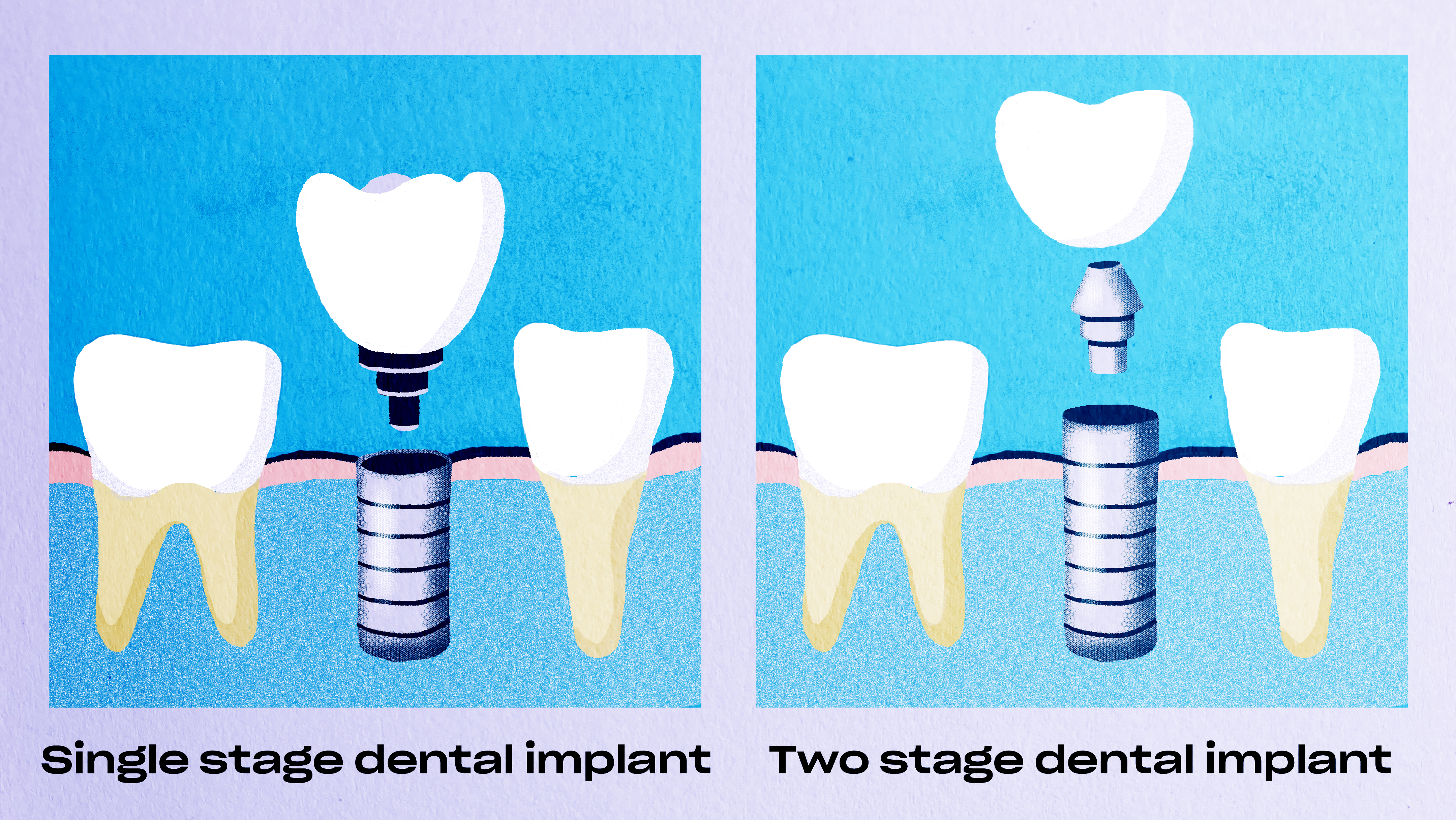 Types of dental implants