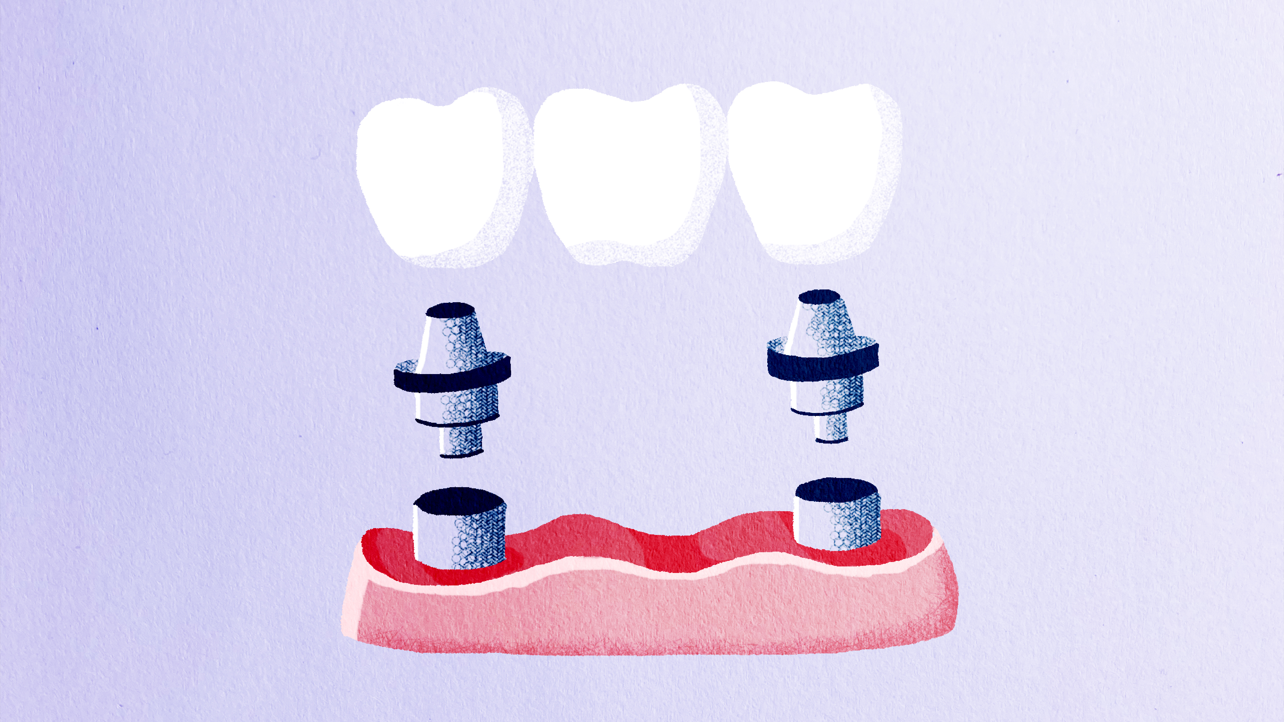 Dental Bridge