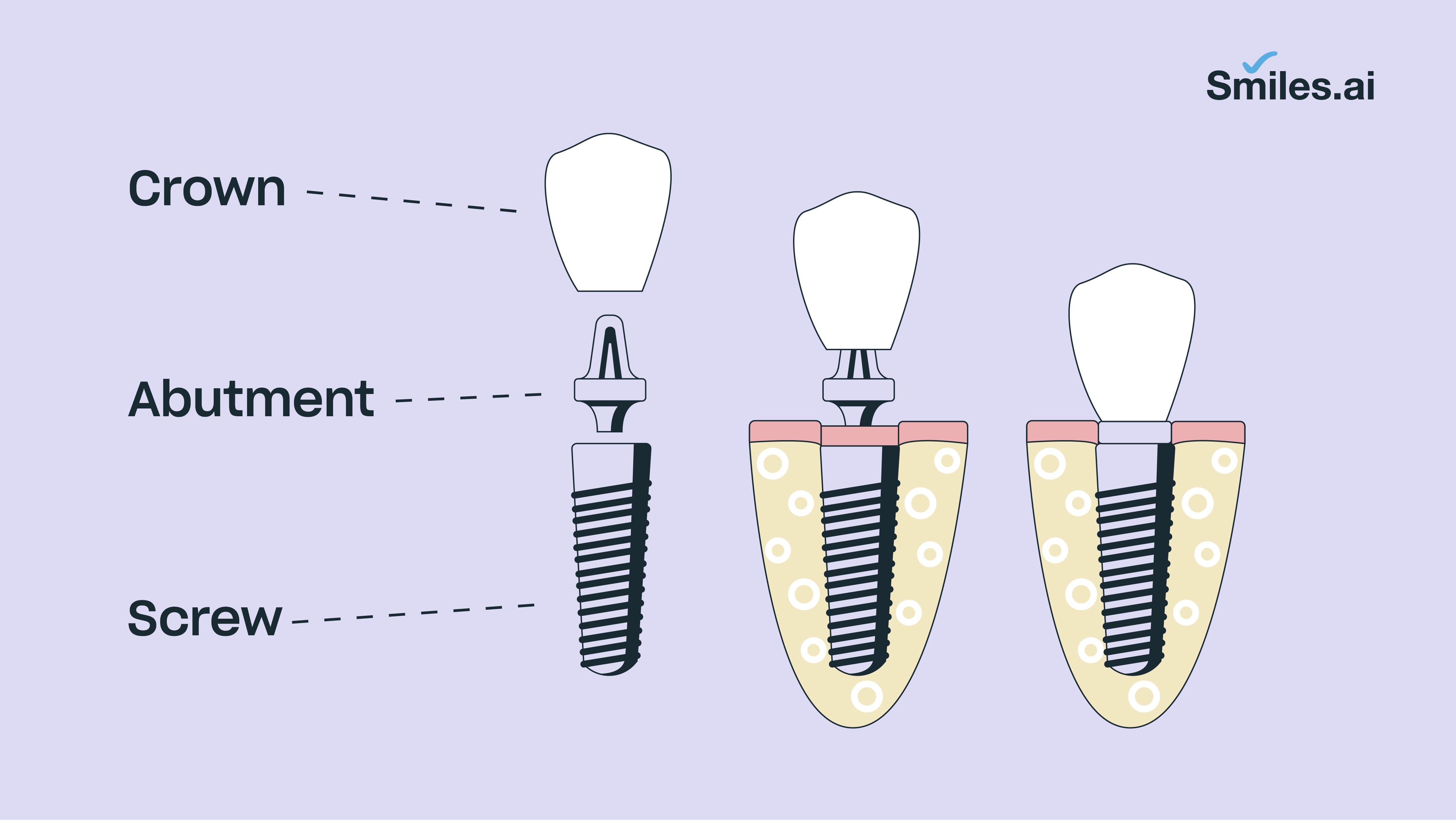 Dental Implant