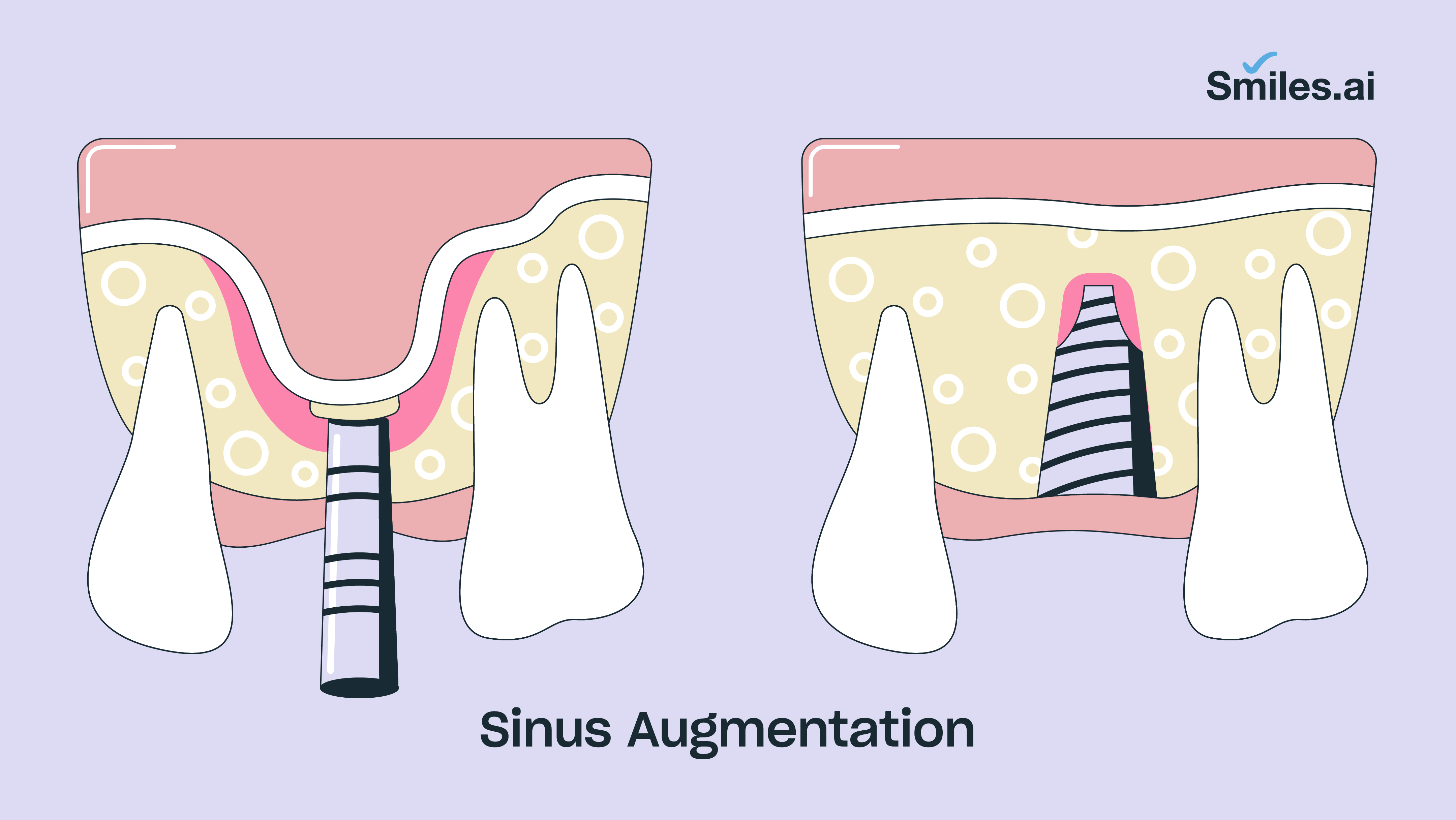 Sinus augmentation