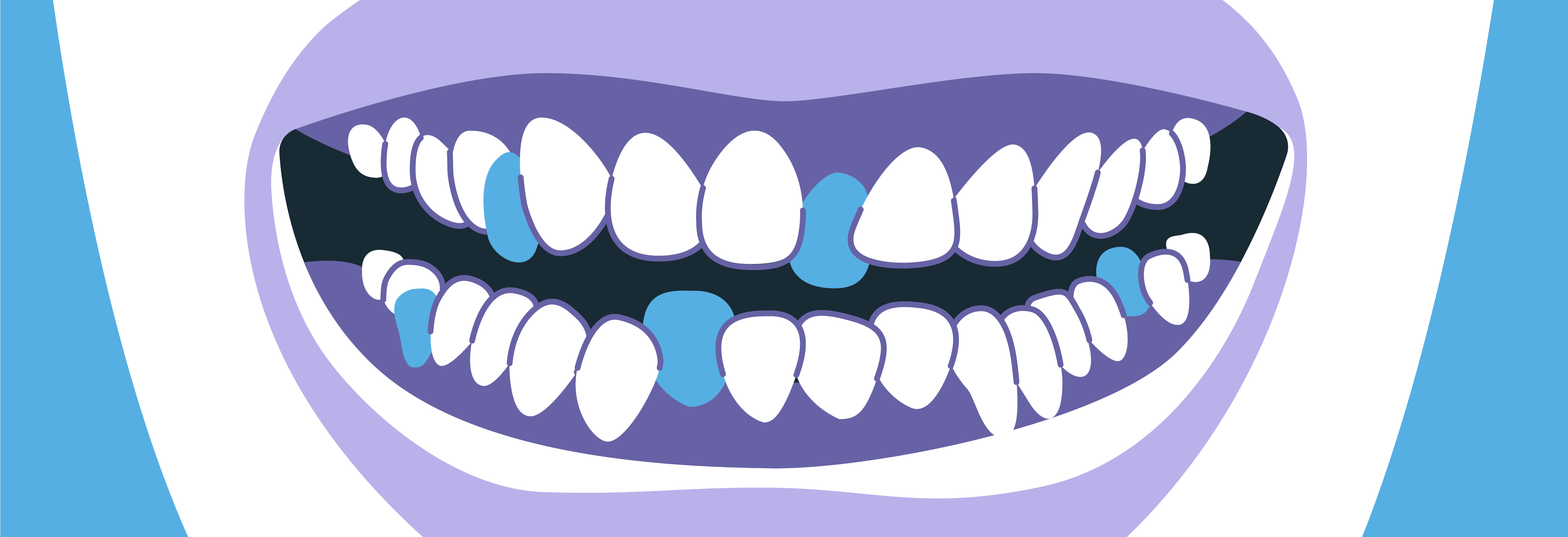 Severe Crowding - Smiles.ai