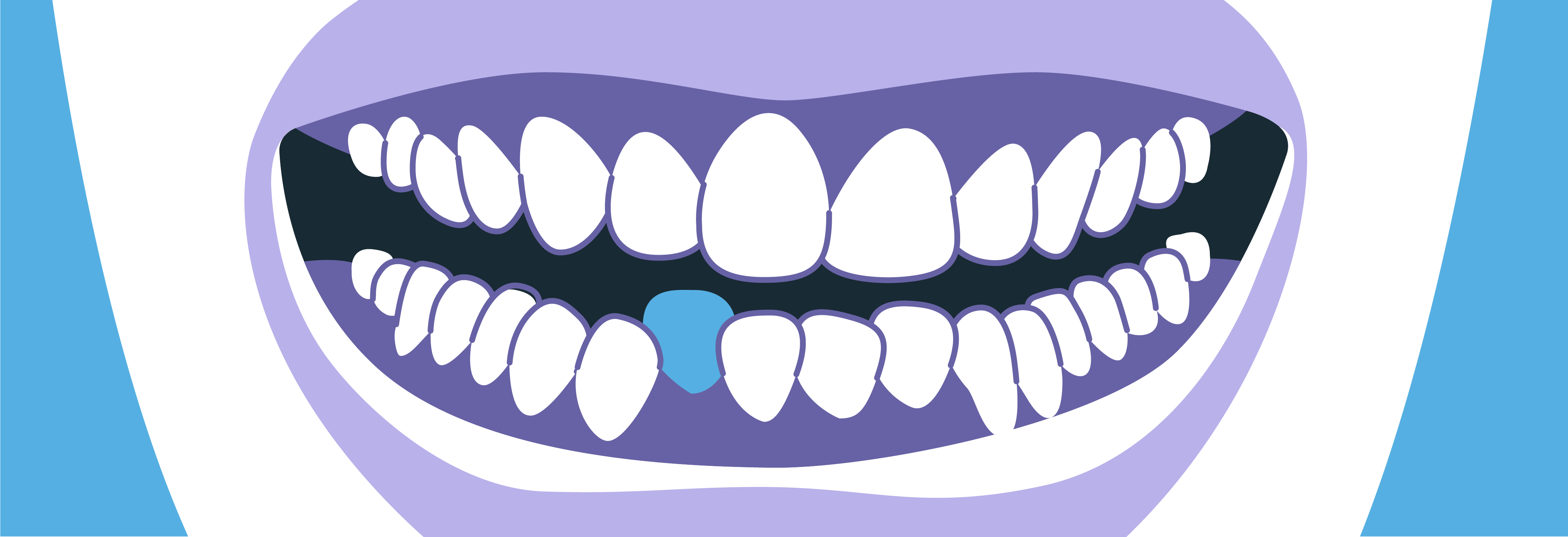 Braces vs Aligners - The Big Choice