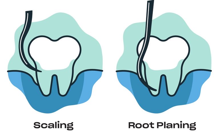 Scaling and root planing