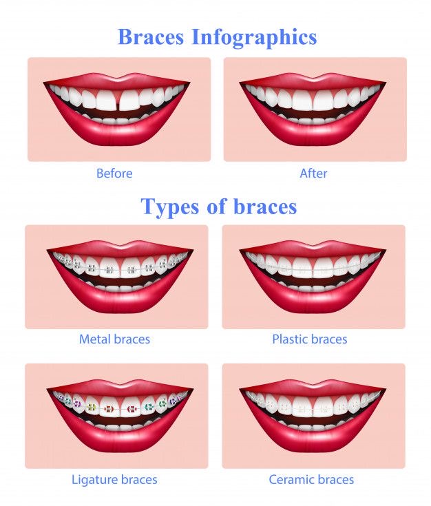 What are Braces and What do they do