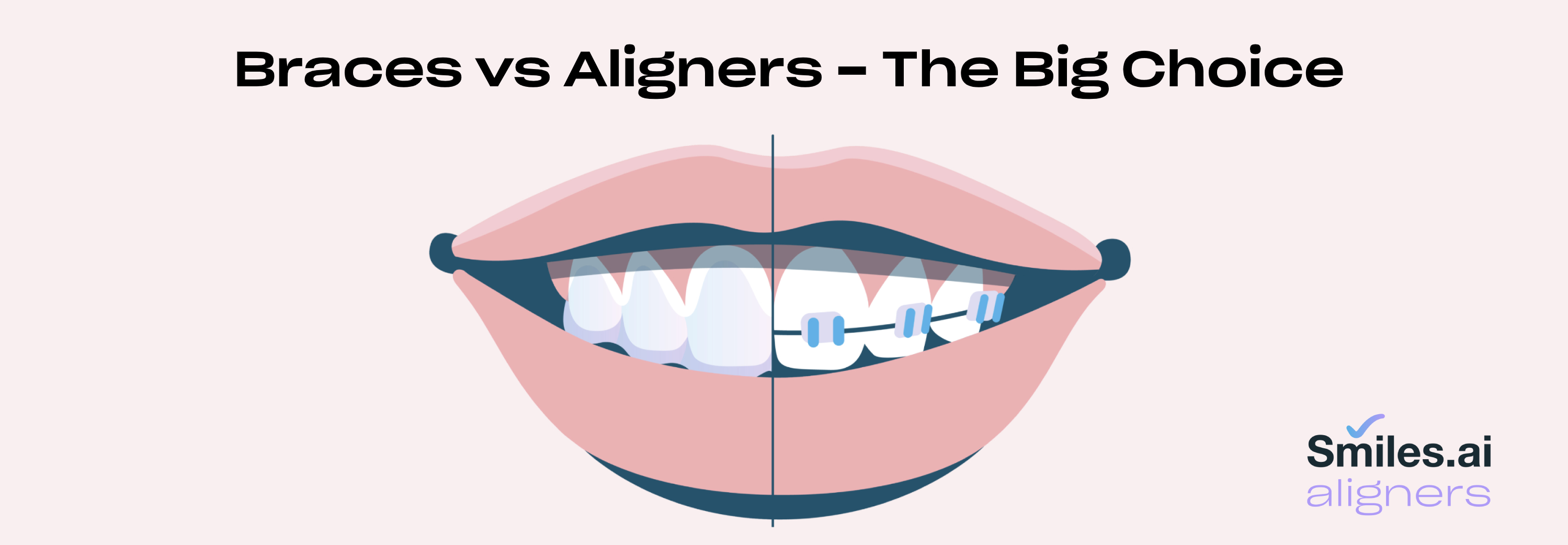 braces vs aligners - smiles.ai