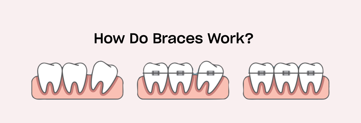 How do braces work? Smiles.ai