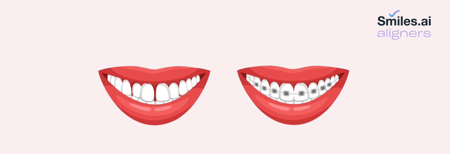 What are the different types of braces? 