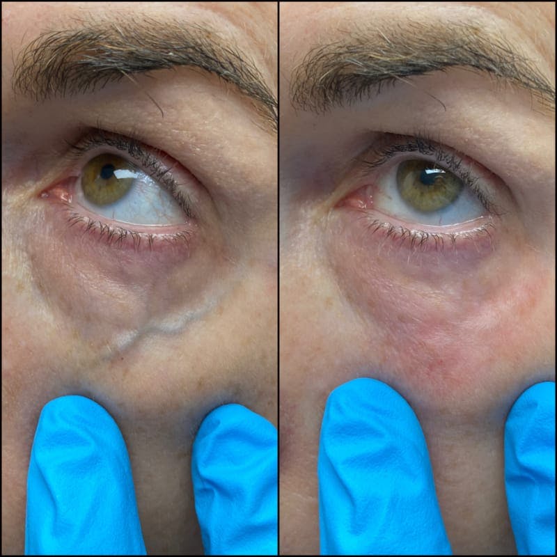 Under-Eye Vein Treatment