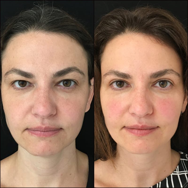 Upper Blepharoplasty Before & After Gallery - Patient 54385588 - Image 2