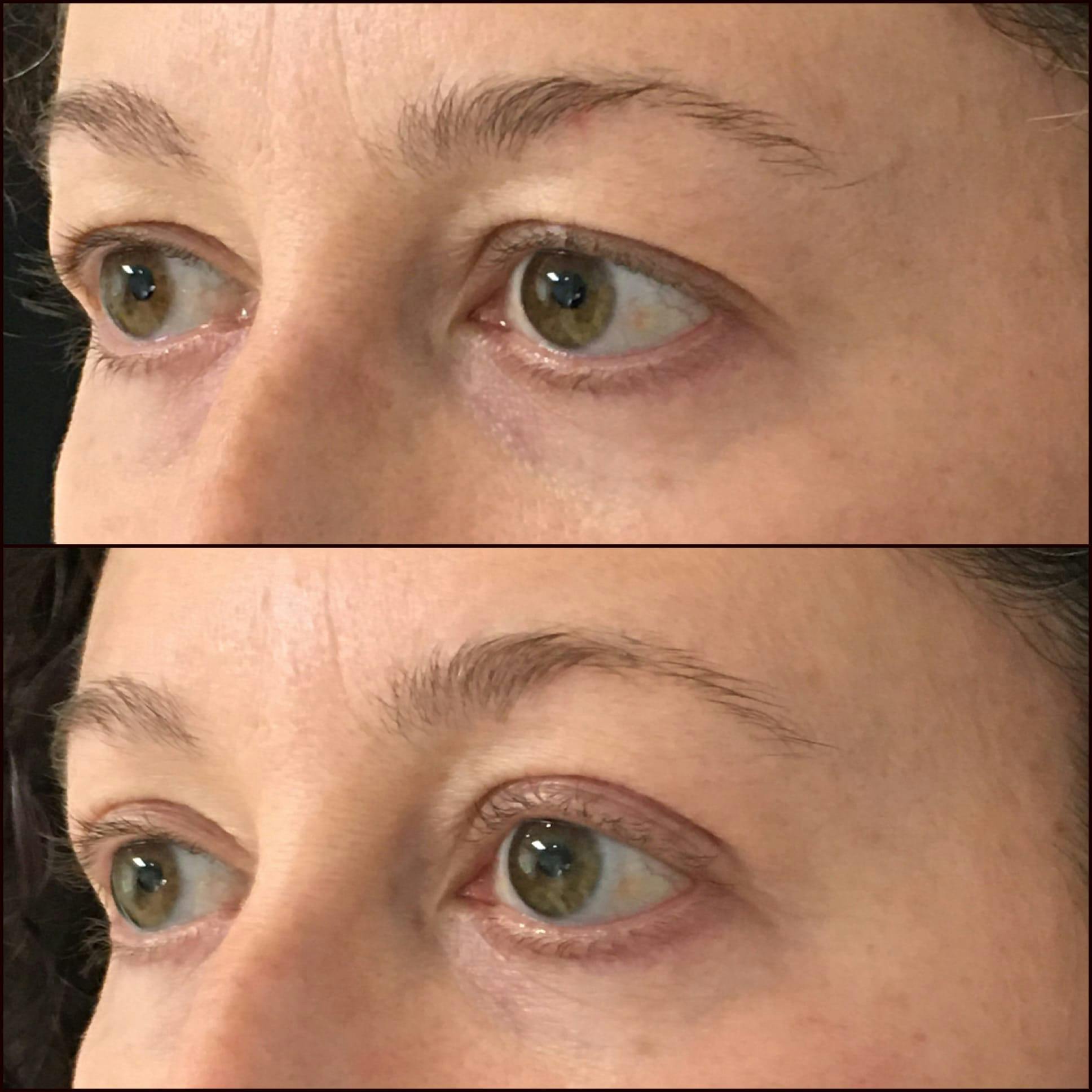 Upper Blepharoplasty Before & After Gallery - Patient 53591719 - Image 1